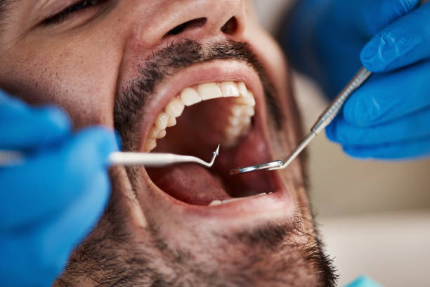 Best Emergency Treatment for Toothache in Larkfield Wikiup, CA