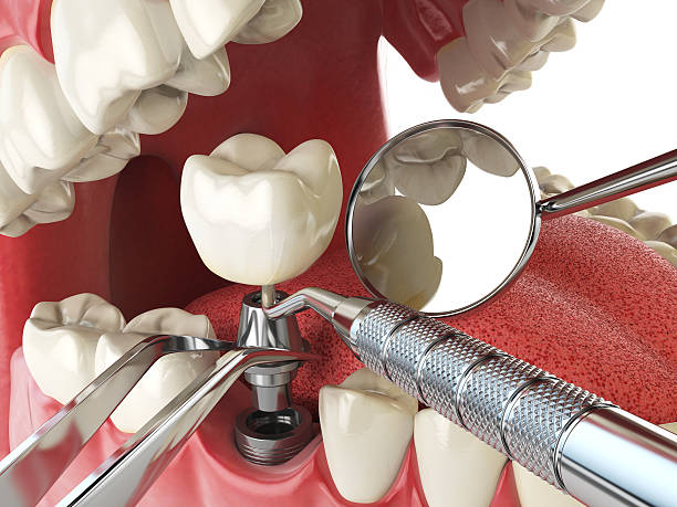 Best Emergency Wisdom Teeth Removal in Larkfield Wikiup, CA